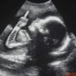 Ultrasound Middlefinger Meme