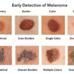 Early Detection of Melanoma