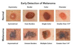 Early Detection of Melanoma