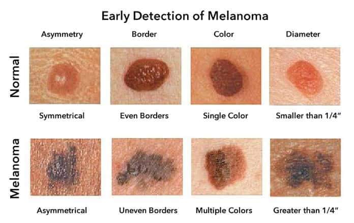 Early Detection of Melanoma - PYGear.com