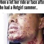 When U Let Her Ride Ur Face After She Had A Hotgirl Summer acne meme
