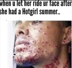 When U Let Her Ride Ur Face After She Had A Hotgirl Summer acne meme